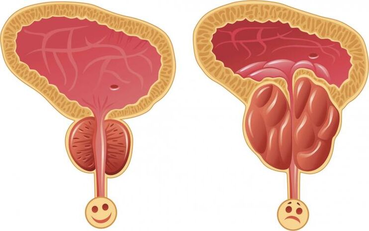 Healthy prostate and prostatitis